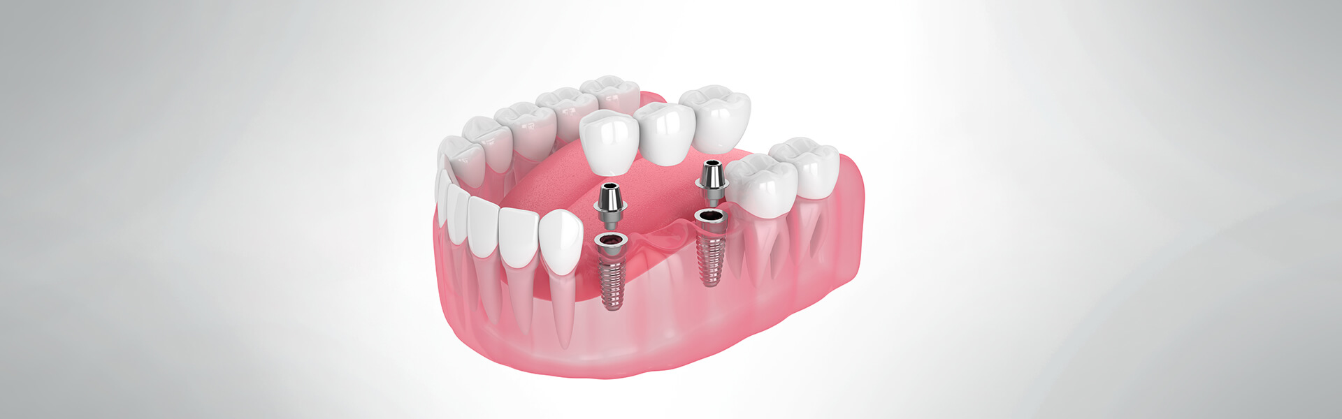 Dental Implants: Advantages, Risks, and Insurance (FAQs)